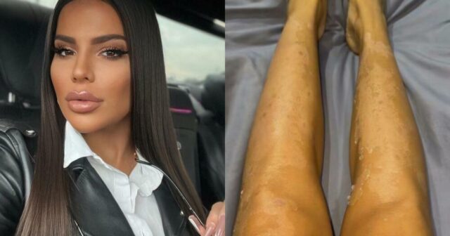 Bədəni çürüyən azərbaycanlı modelin son durumu ürək sızlatdı – VİDEO