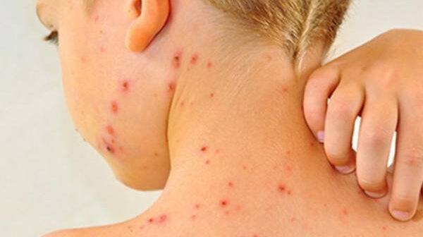 YAYILMAQDA OLAN QIZILCA XƏSTƏLİYİNDƏN UŞAQLARI NECƏ QORUYAQ? – PEDİATR