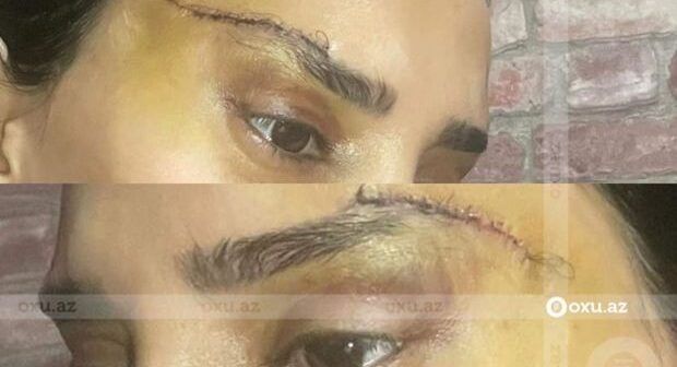 Bakıda estetik əməliyyatla bağlı ŞİKAYƏT: “10 min manat verməsən, səni biabır edəcəyəm”