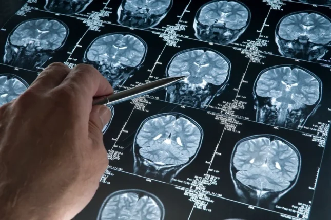 Alzheimer atadan keçir?
