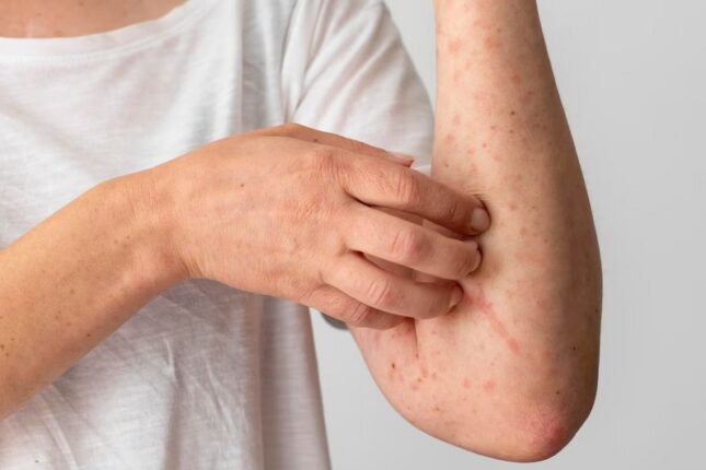 Alimlər hər il 11 milyon insanı öldürən infeksiyanı dayandıra bilən anticisim yaradıblar