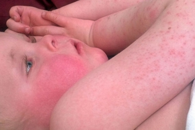 SOS! Bağça və məktəblərdə bu virus yayılıb… SOS! Bağça və məktəblərdə bu virus yayılıb…